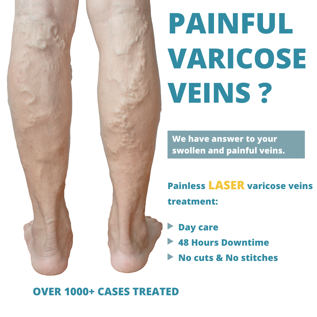 laser varicose veins surgery in delhi