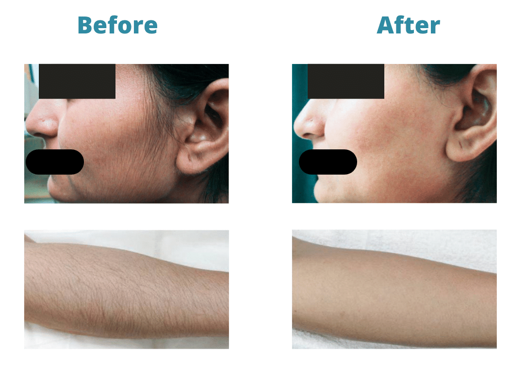 Permanent Laser Hair Removal  Best In Chennai  Smaavins