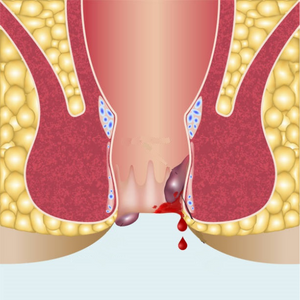Pain and swelling around the anus